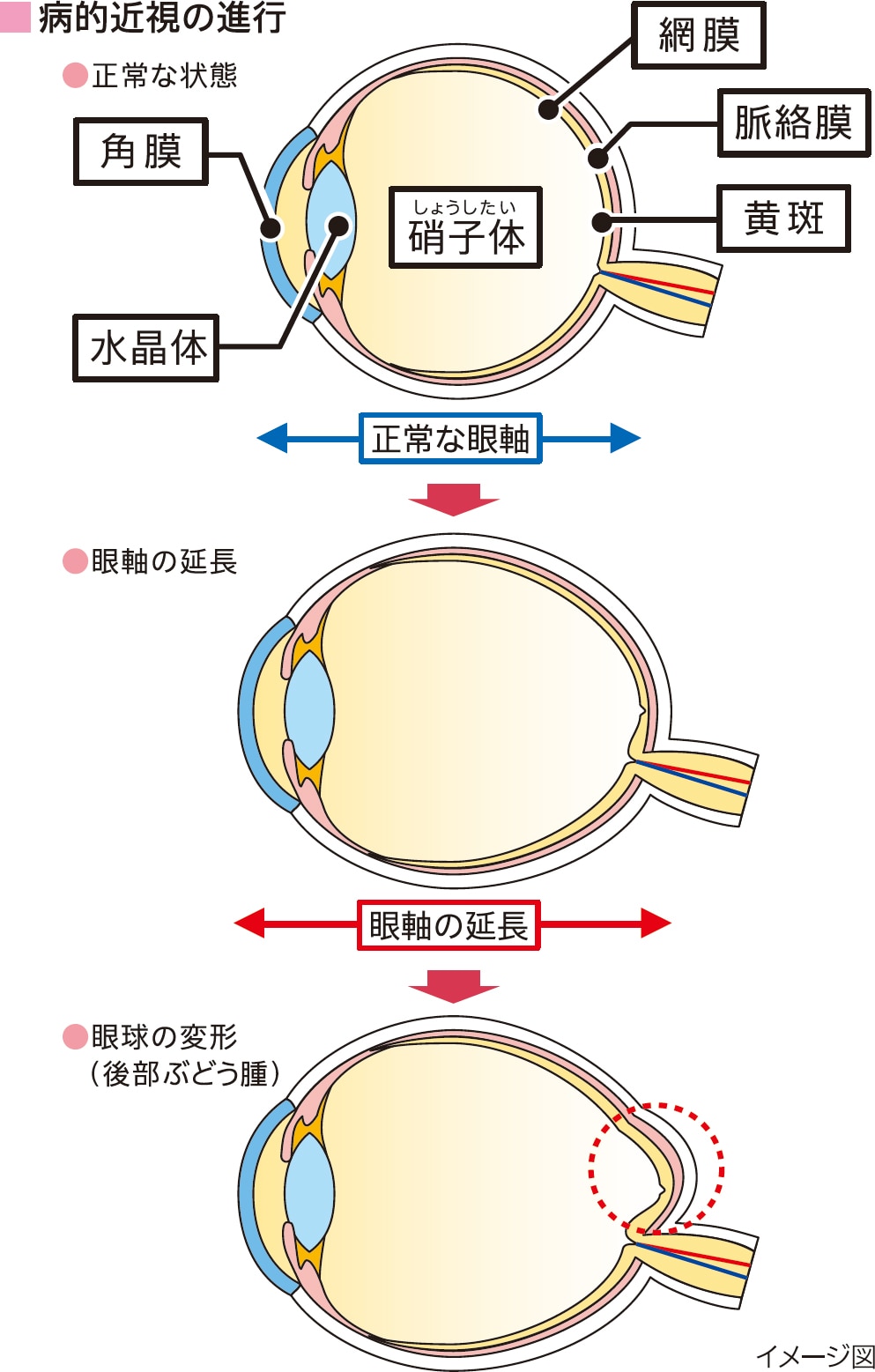 病的近視の進行