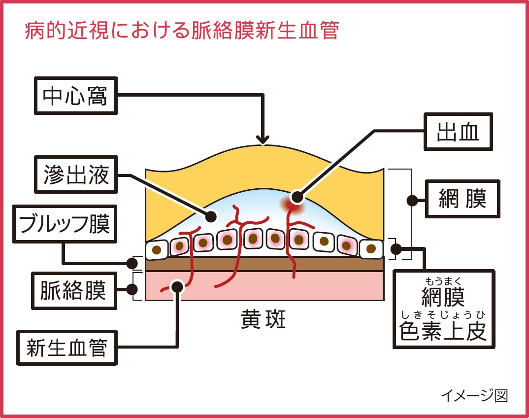 病的近視における脈絡膜新生血管