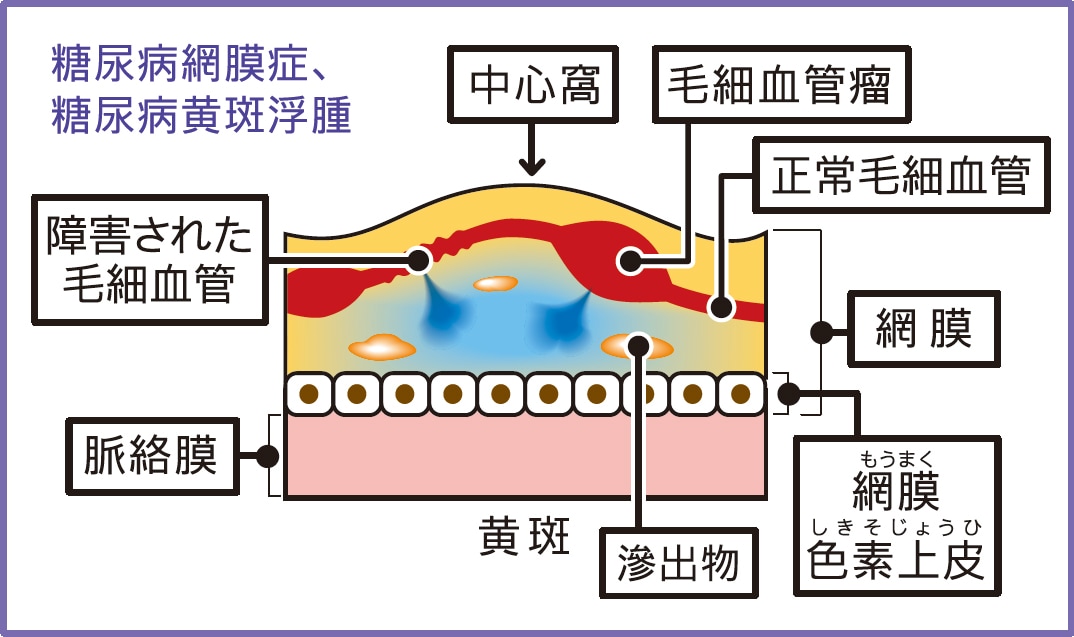 糖尿病黄斑浮腫とは