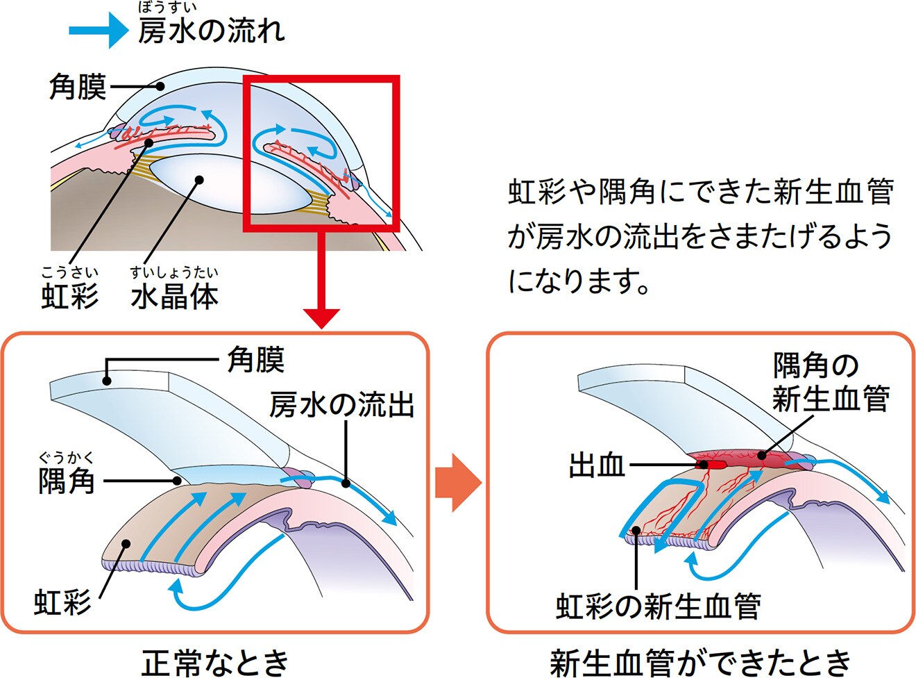 虹彩や隅角にできた新生血管が房水の流出をさまたげるようになります