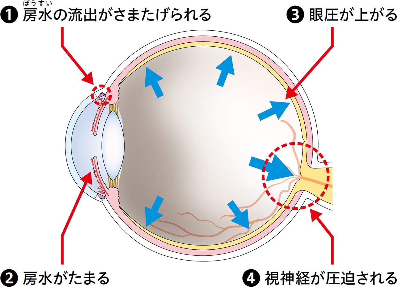 房水の流出がさまたげられることにより眼圧が上がり、視神経が圧迫され、視力・視野が悪化します