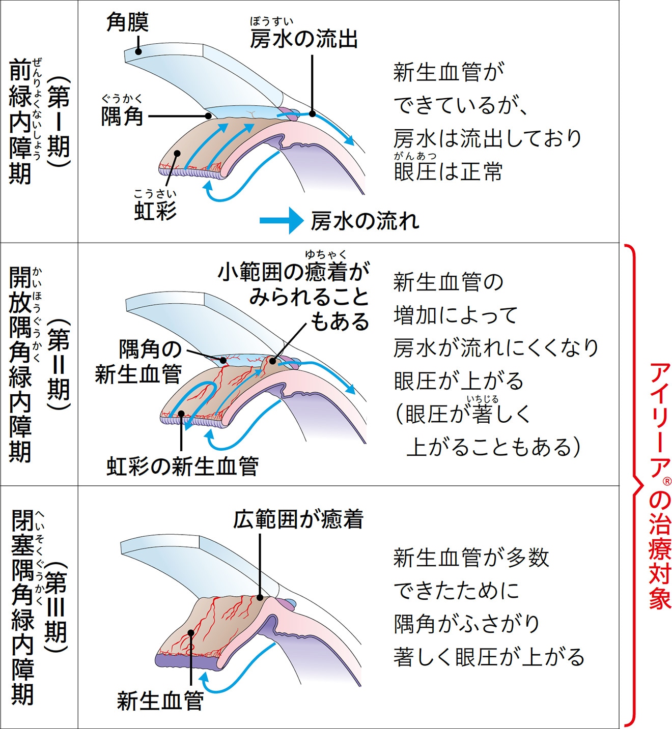 血管新生緑内障けっかんしんせいりょくないしょうの進行度による分類