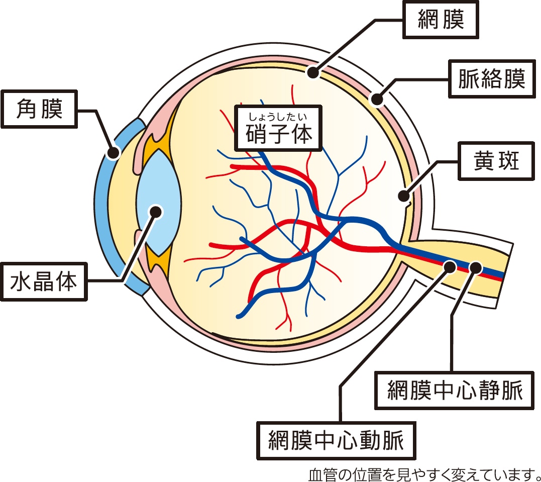 網膜静脈閉塞症とは