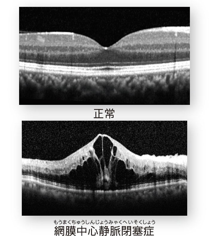 光干渉断層計(OCT) 光干渉断層計(OCT)