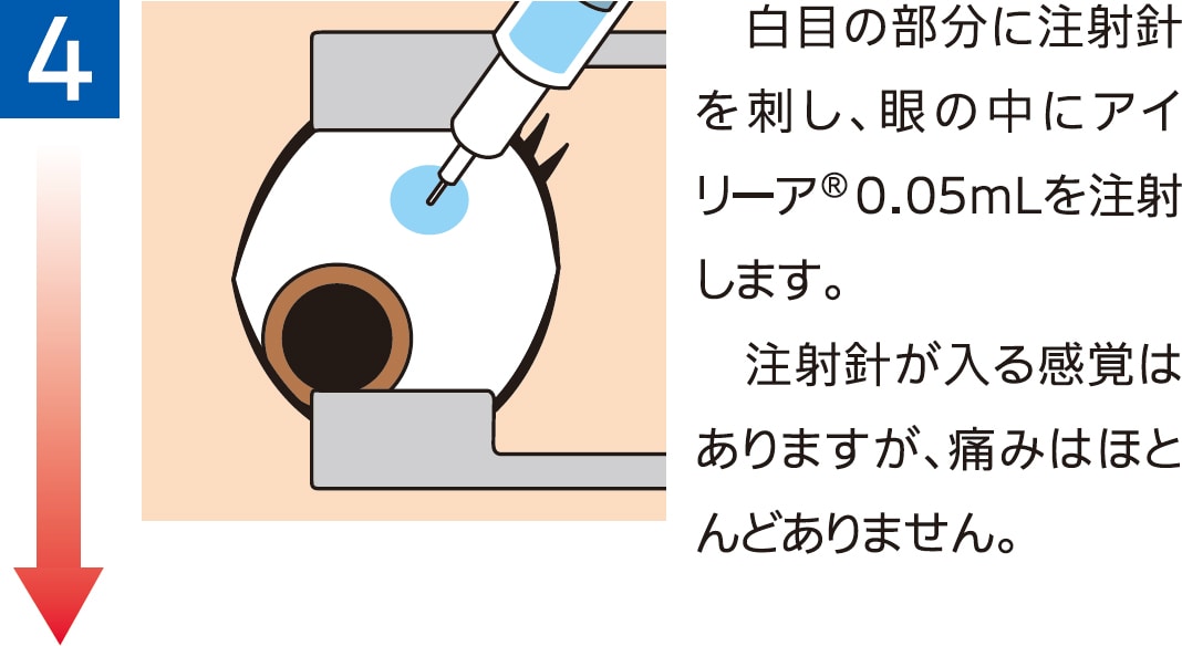 治療当日のながれ4 治療当日のながれ4