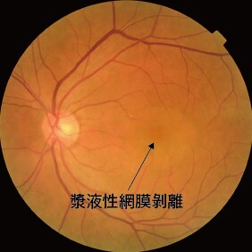 眼底写真