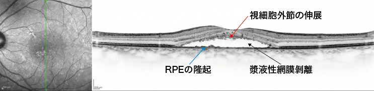OCT画像