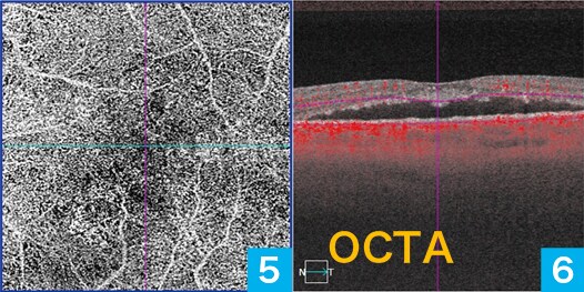 OCTA画像