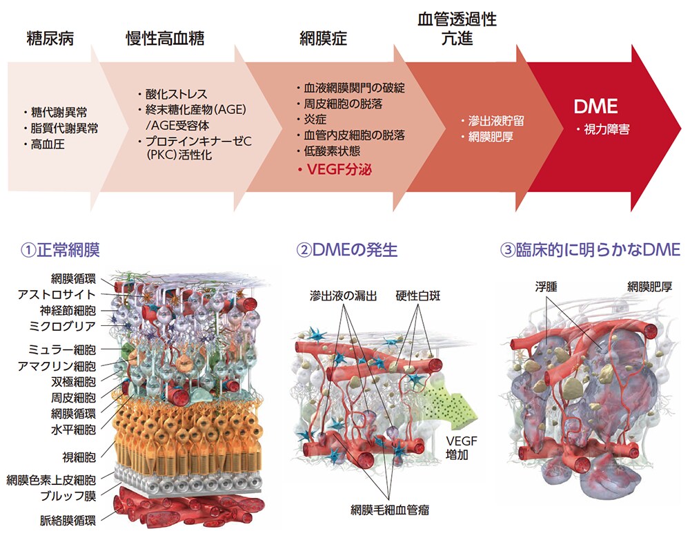 DMEの原因