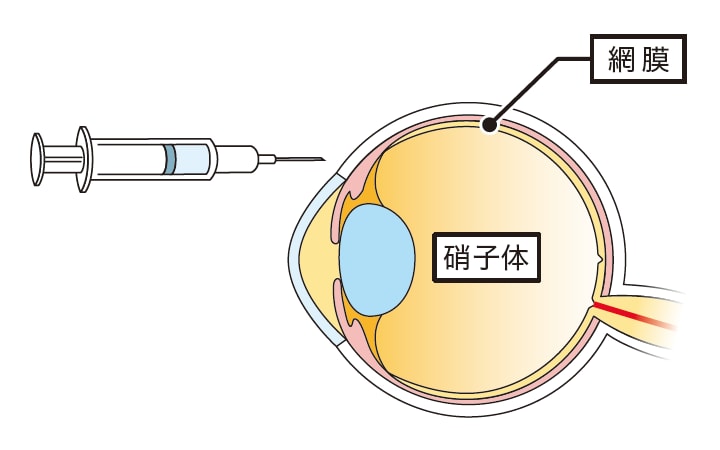 アイリーア®の注射方法