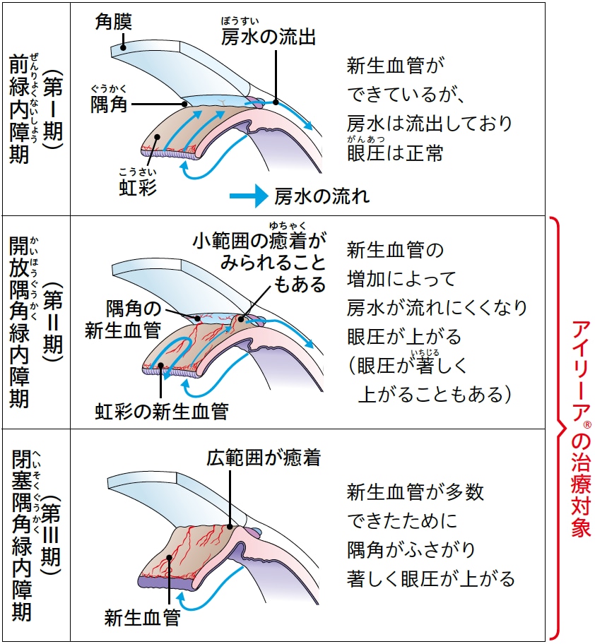 血管新生緑内障の進行度による分類