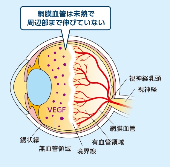 ROPの病態のイラスト