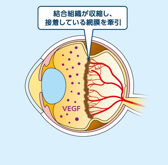 ROPによる網膜剥離のイラスト