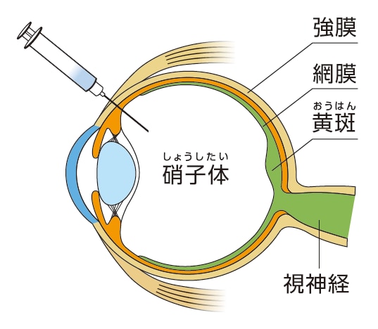 アイリーア®8mgによる治療法:硝子体内注射のイラスト