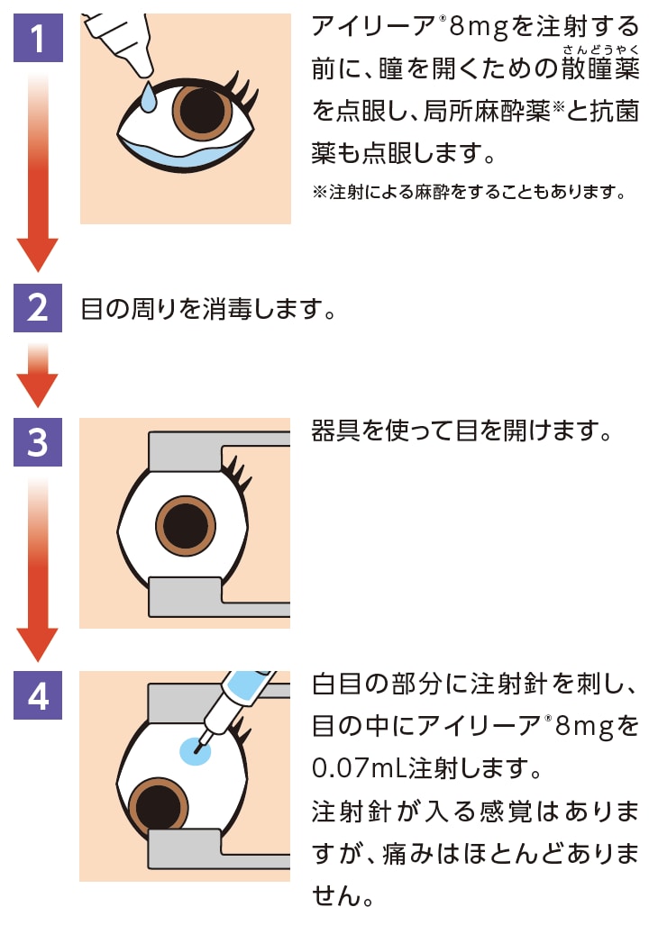 糖尿病黄斑浮腫:アイリーア®8mgによる投与方法の流れのイメージ図