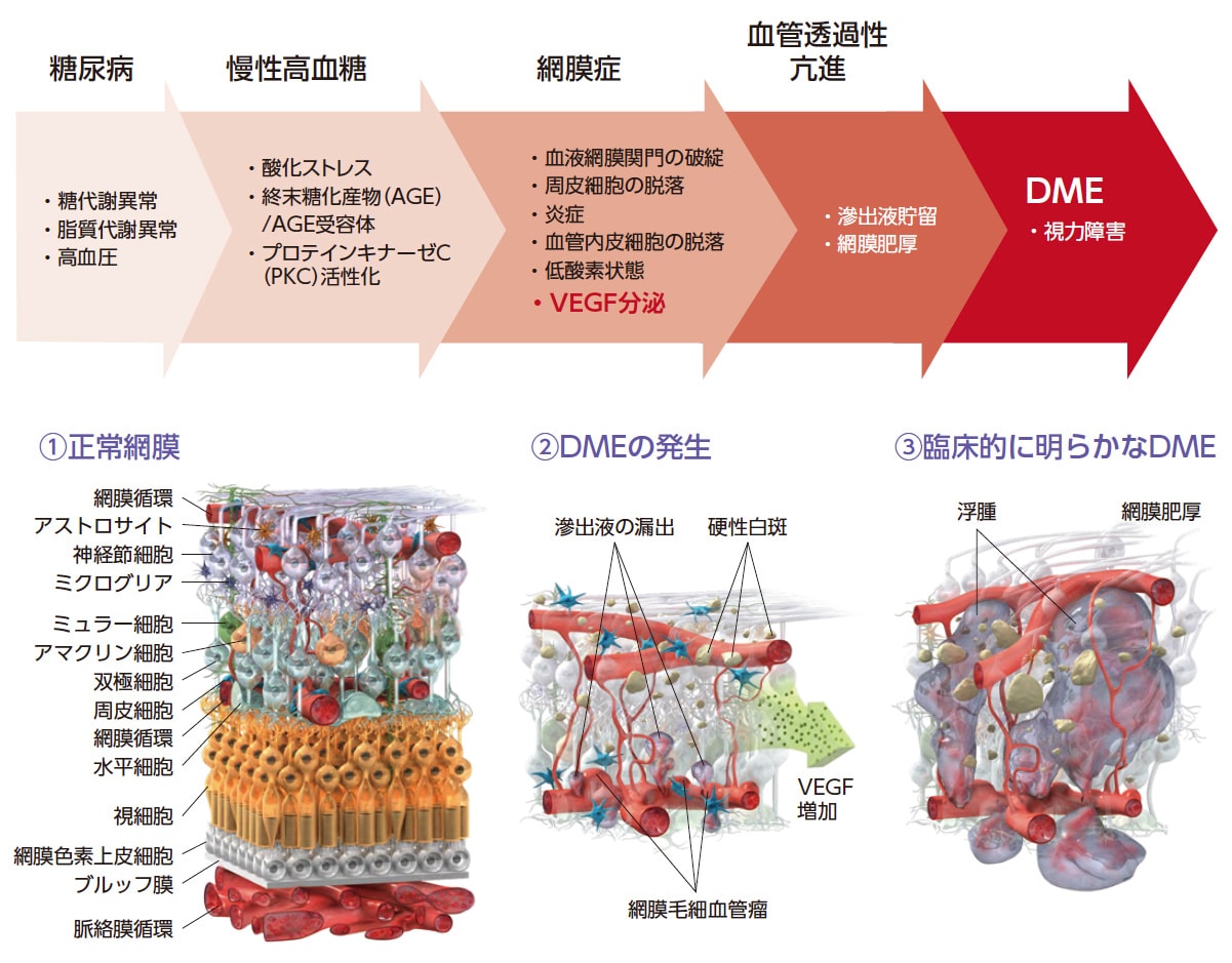 DMEの原因とその病態を表した図解