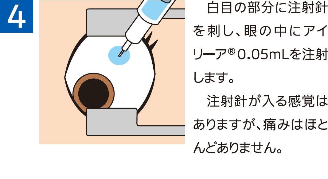 治療当日のながれ4 治療当日のながれ4