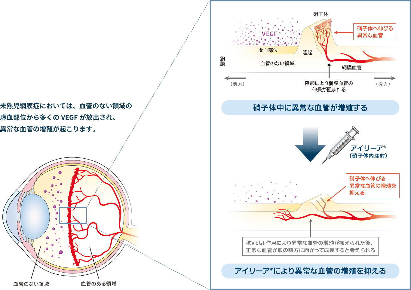 アイリーアによる治療法