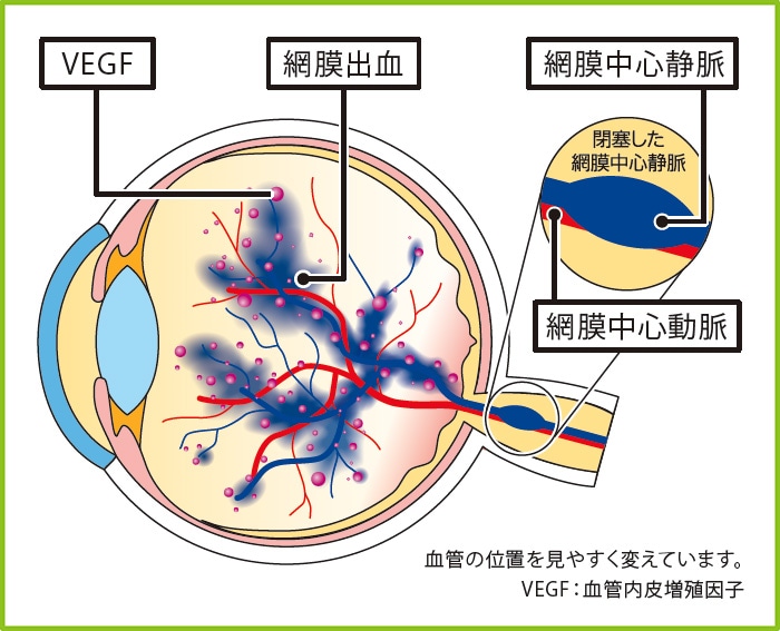 網膜中心静脈閉塞症