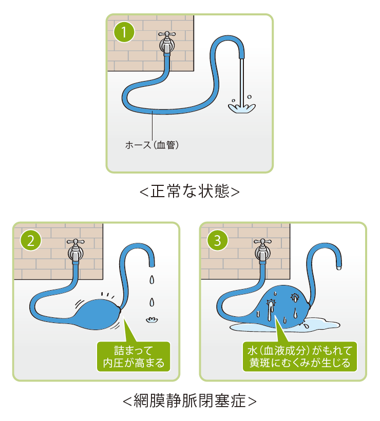 網膜静脈閉塞症と黄斑浮腫のイラスト