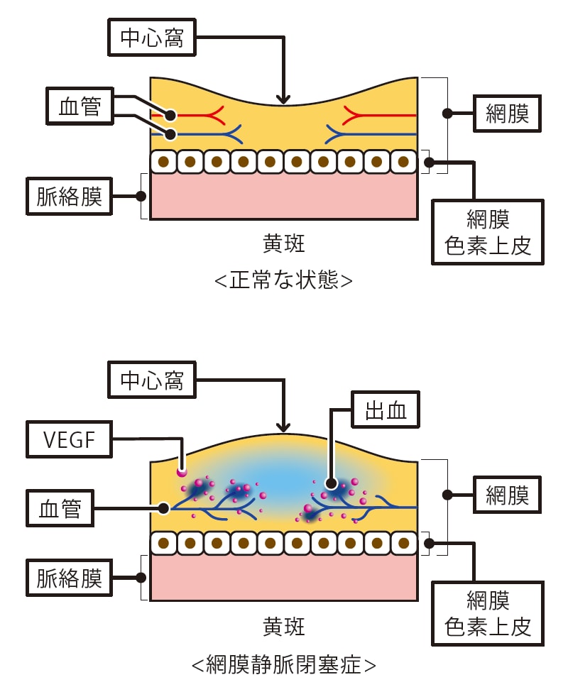 黄斑浮腫とVEGFのイラスト