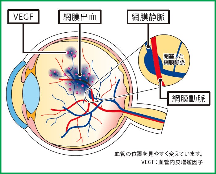 網膜静脈分枝閉塞症のイラスト