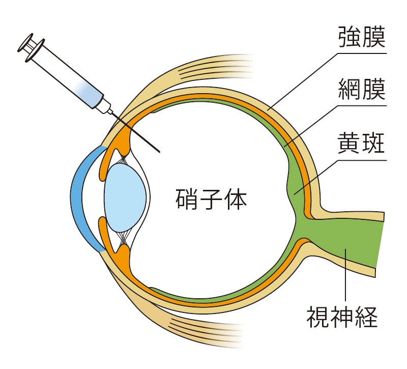 硝子体内注射のイメージ図