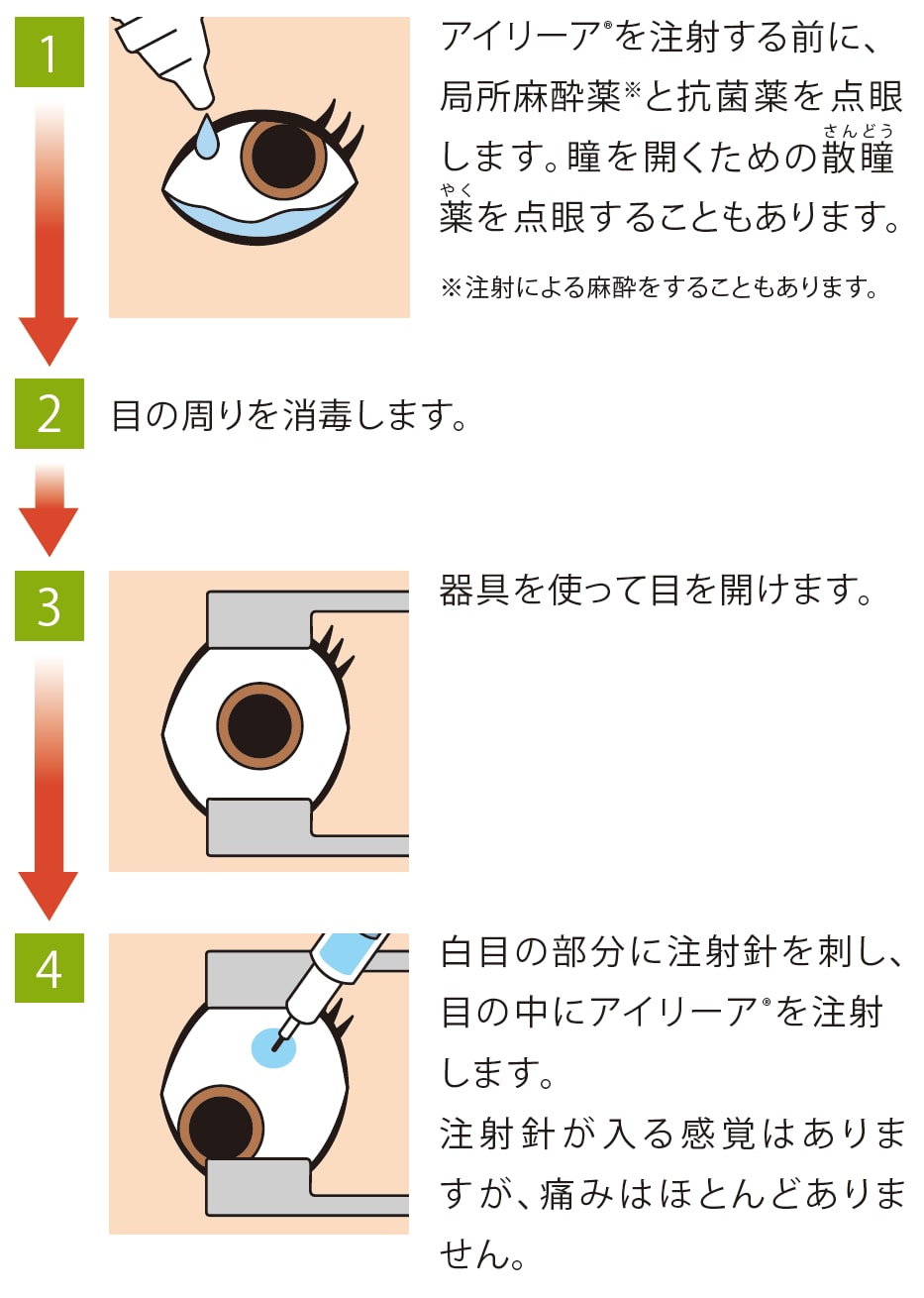 投与方法の手順イラスト